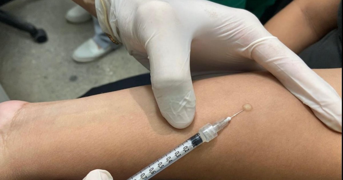 Tratamento preventivo contra tuberculose pode durar três meses em Manaus